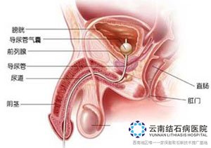 尿道结石最新研究及治疗进展综述