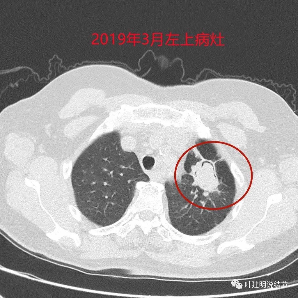 纵隔位置最新研究进展，探究其对临床意义的深远影响